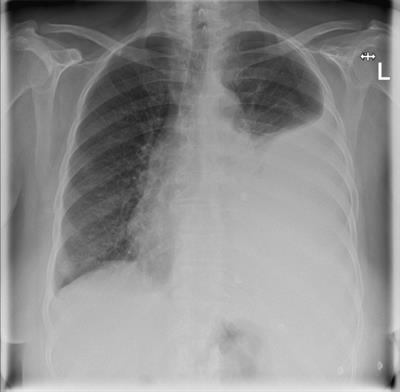 Case Report: Epithelioid angiosarcoma of the pleura